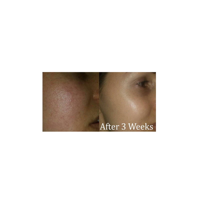 Results of using Regentiv's Problem Skin Lotion